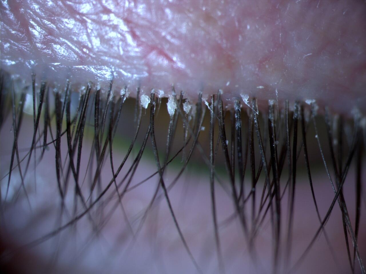 Blepharitis showing crusting and flakes at the base of the lashes