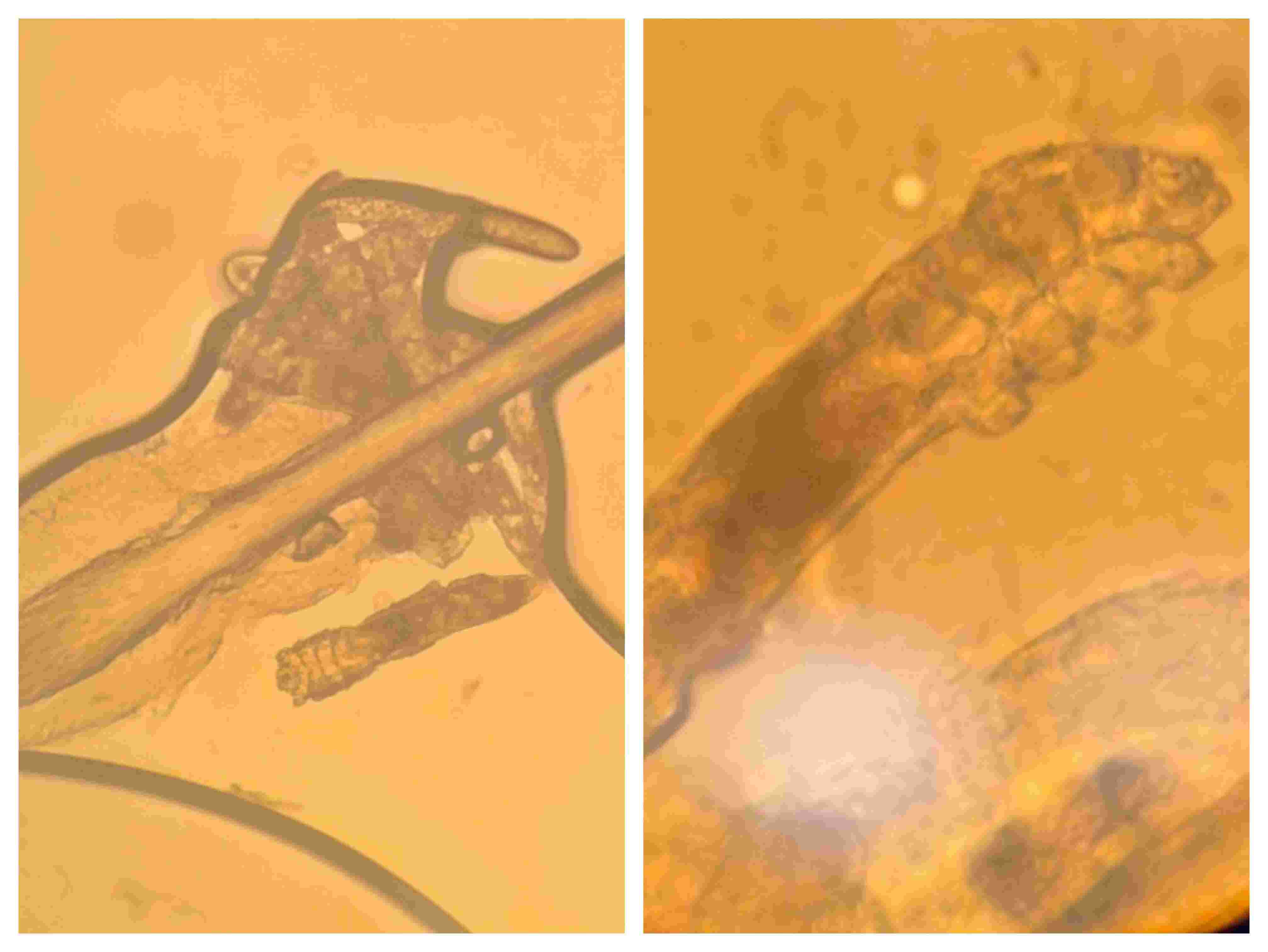 Demodex mite infestation of eyelash